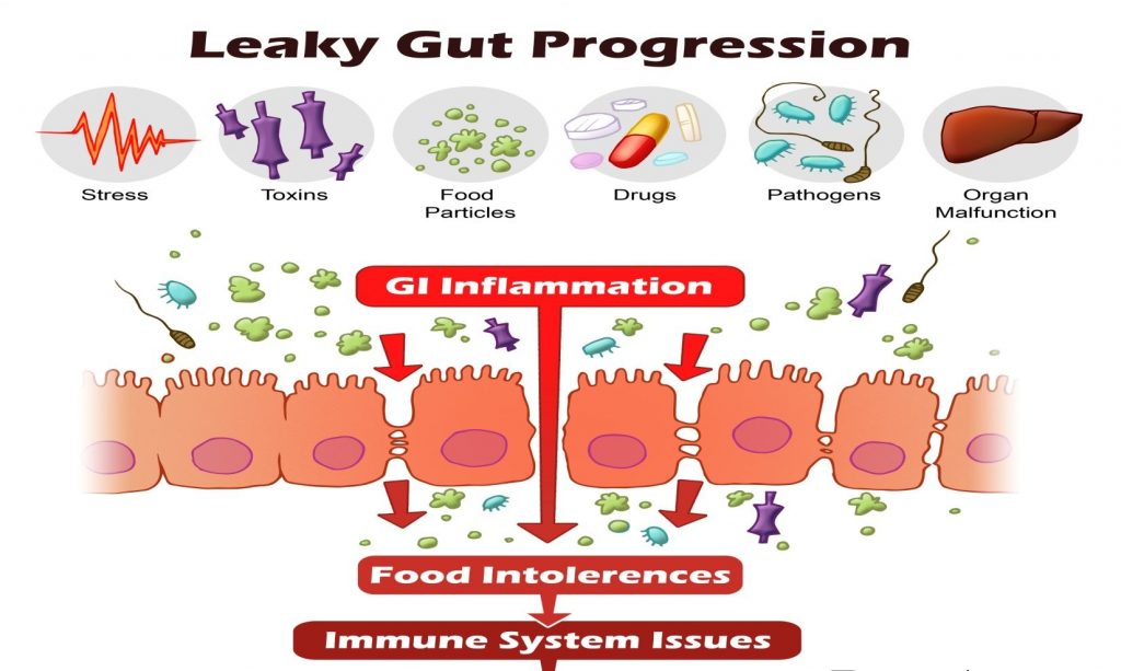 Causes-of-Leaky-Gut-Syndrome-Leaky-Gut-Progression